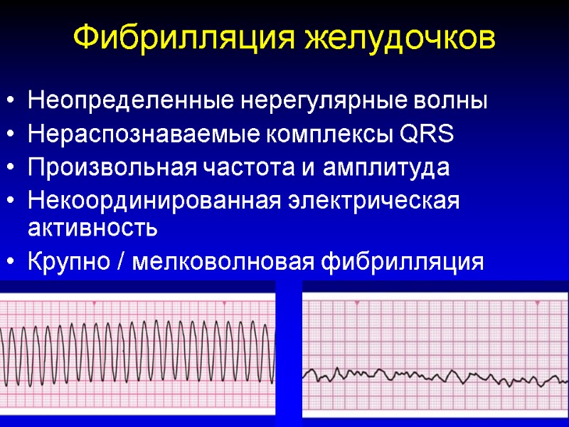 Фибрилляция желудочков Неопределенные нерегулярные волны Нераспознаваемые комплексы QRS  Произвольная частота и амплитуда Некоординированная